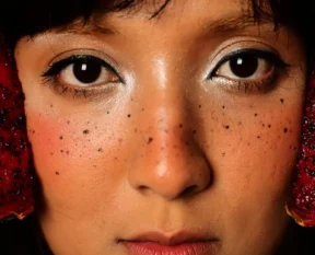 dark spot treatment — Dark Spot Treatments for Post-Acne Marks
